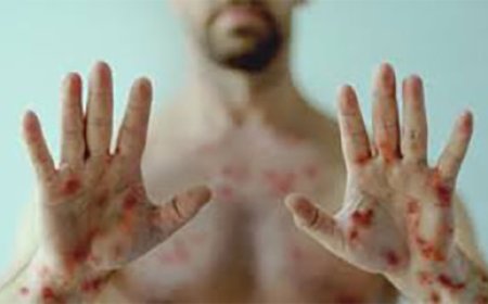 WHO ने Mpox के टीके के इस्तेमाल को दी मंजूरी, सबसे पहले इस देश में किया जाएगा Vaccination